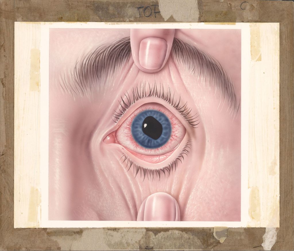 Miniature of Booklet on Common Eye Disorders, Iridocyclitis