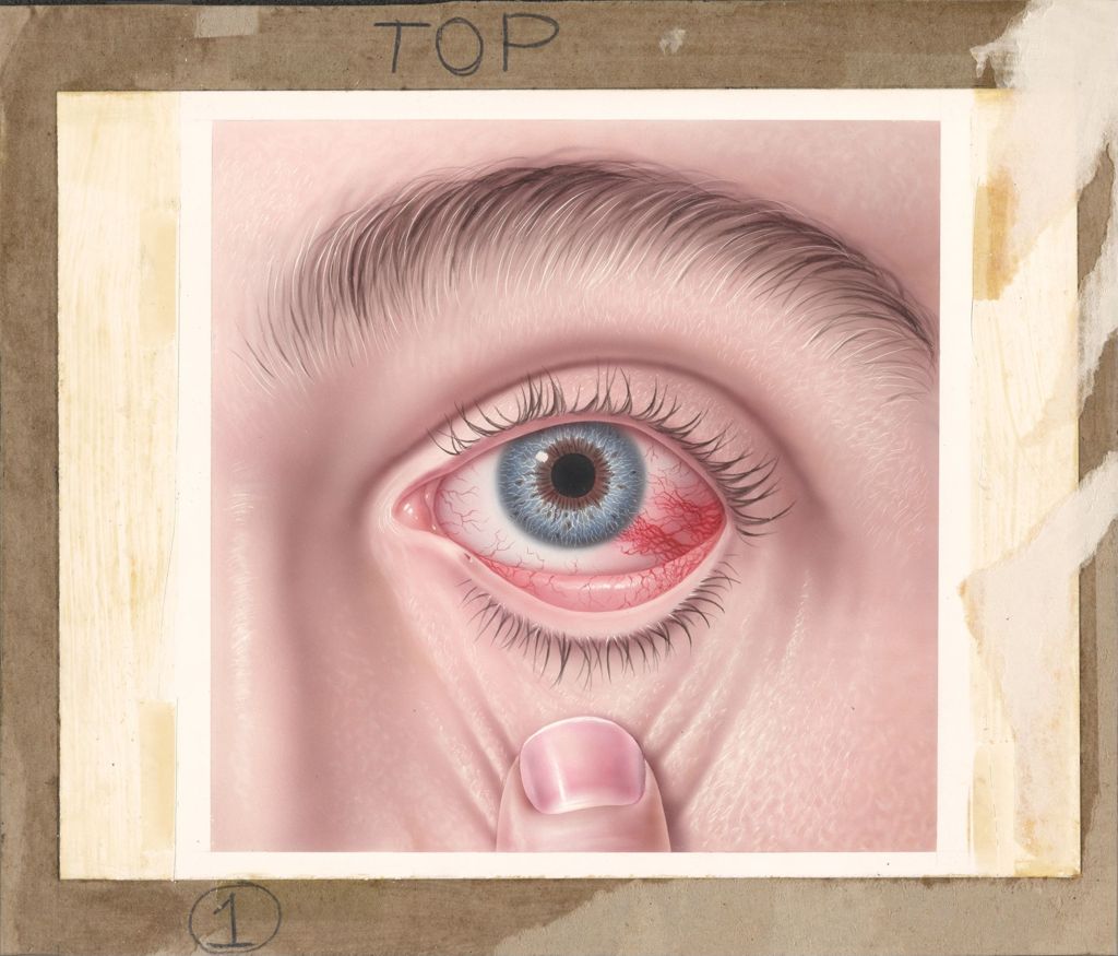 Miniature of Booklet on Common Eye Disorders, Episcleritis