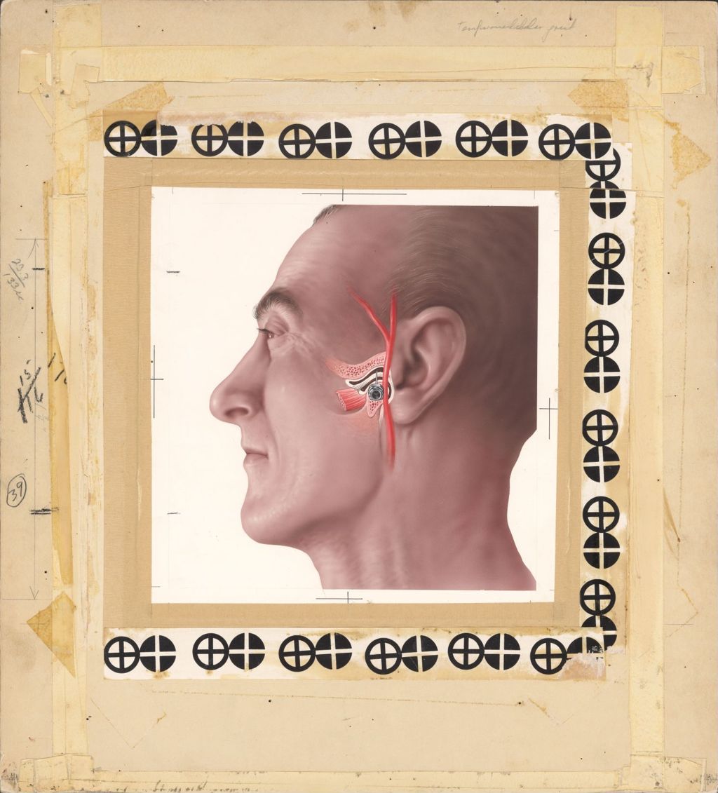 Miniature of Hydrocortone Intra-Articular, Artwork of man's face with needle insertion point in temple