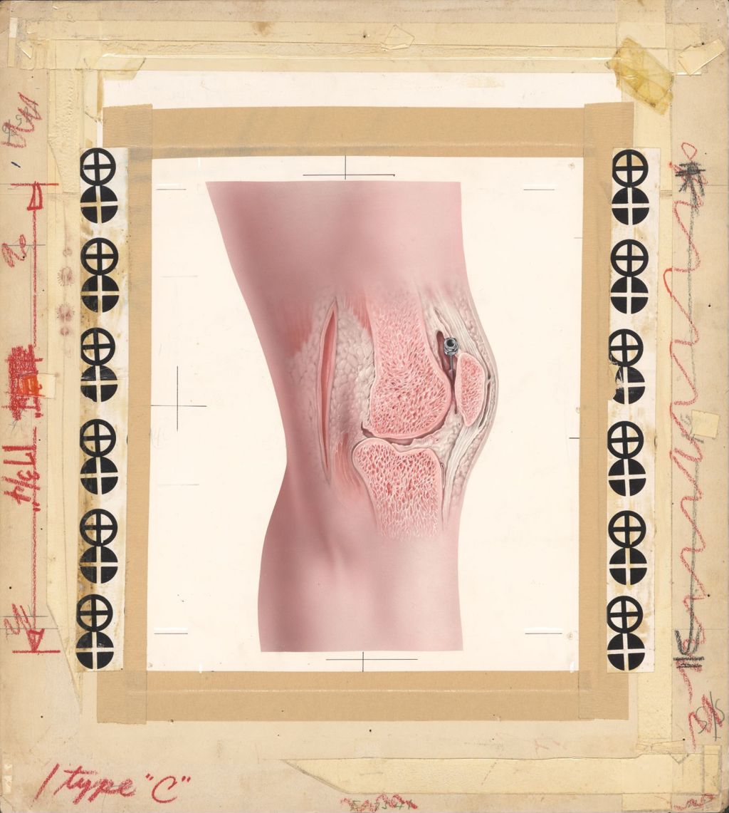 Miniature of Hydrocortone Intra-Articular, Artwork of knee with needle insertion point under kneecap