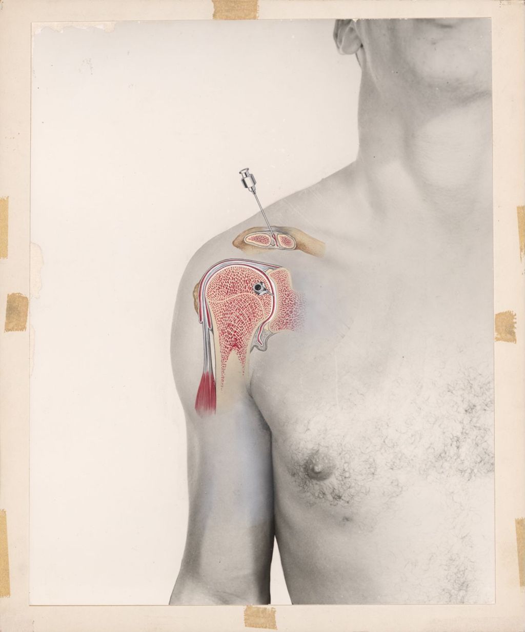 Miniature of Injection of Hydrocortone, Drawing on top of photograph of man's shoulder, showing needle insertion points