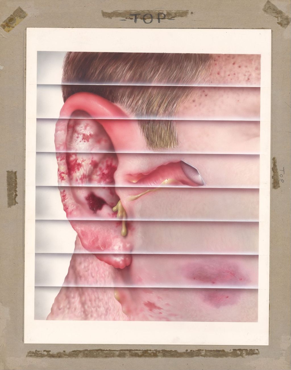Miniature of Composite of Ear Diseases (External)