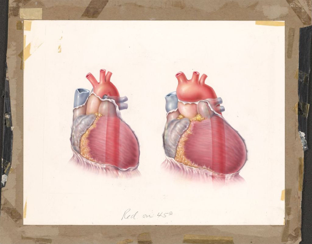 Miniature of Diupres and Hydropres, Left, Normal Heart and Aorta, Right, Hypertensive Arteriosclerotic Heart Disease