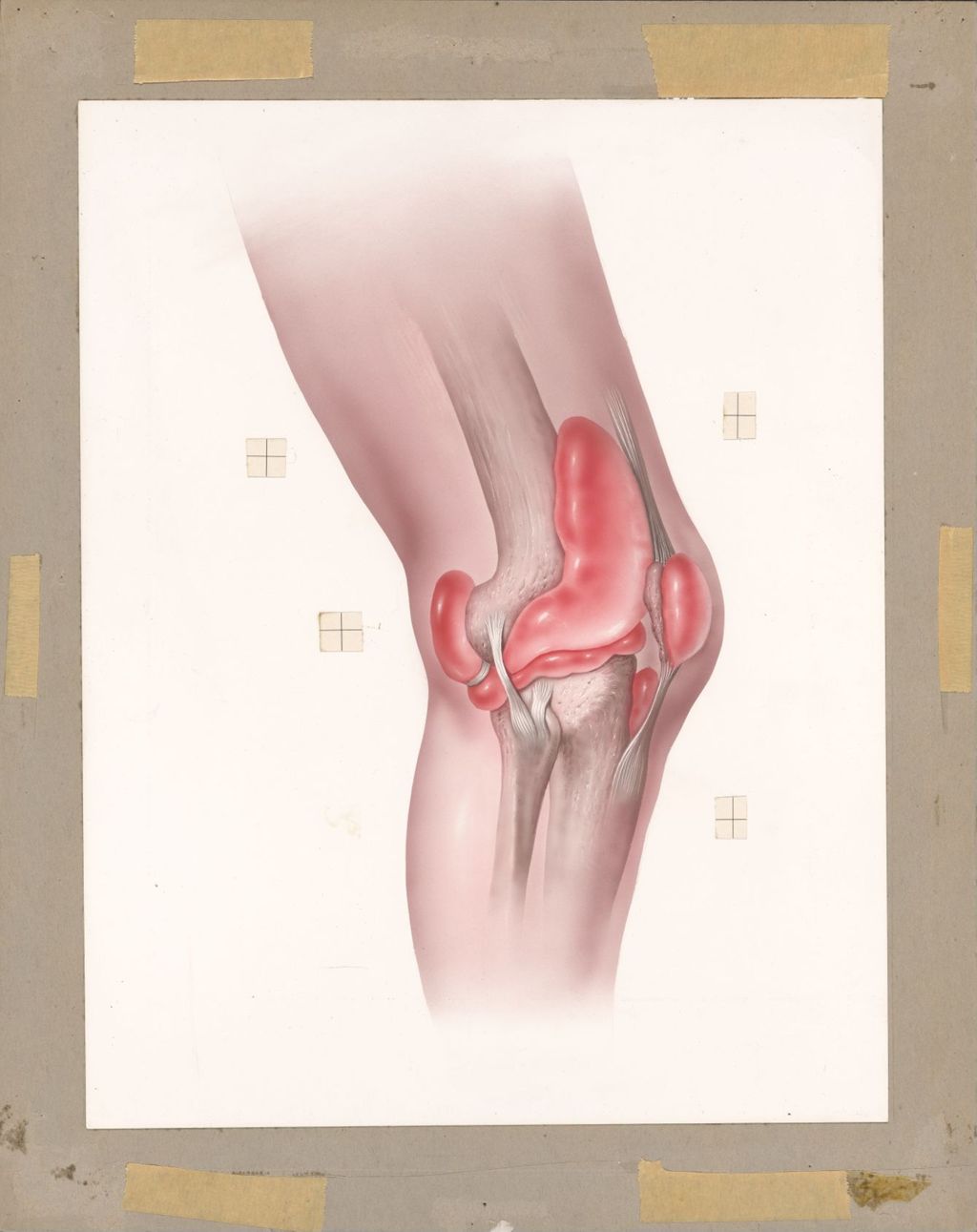 Miniature of Inflamed Capsule Inflammation of Knee Joint