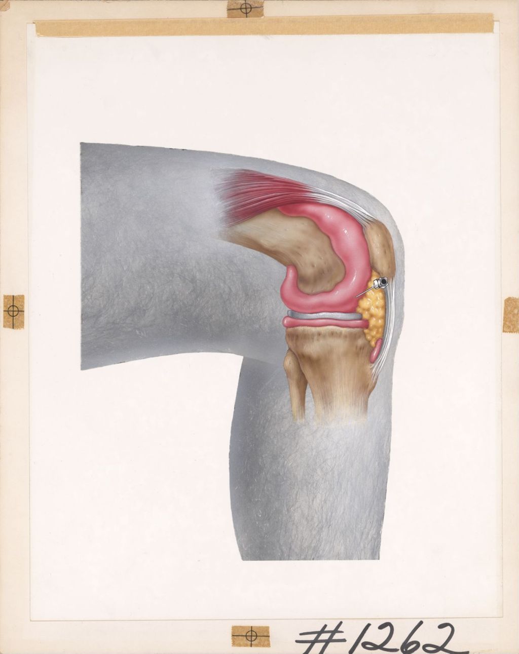 Miniature of Drawing on top of photograph of man's knee, showing needle insert points