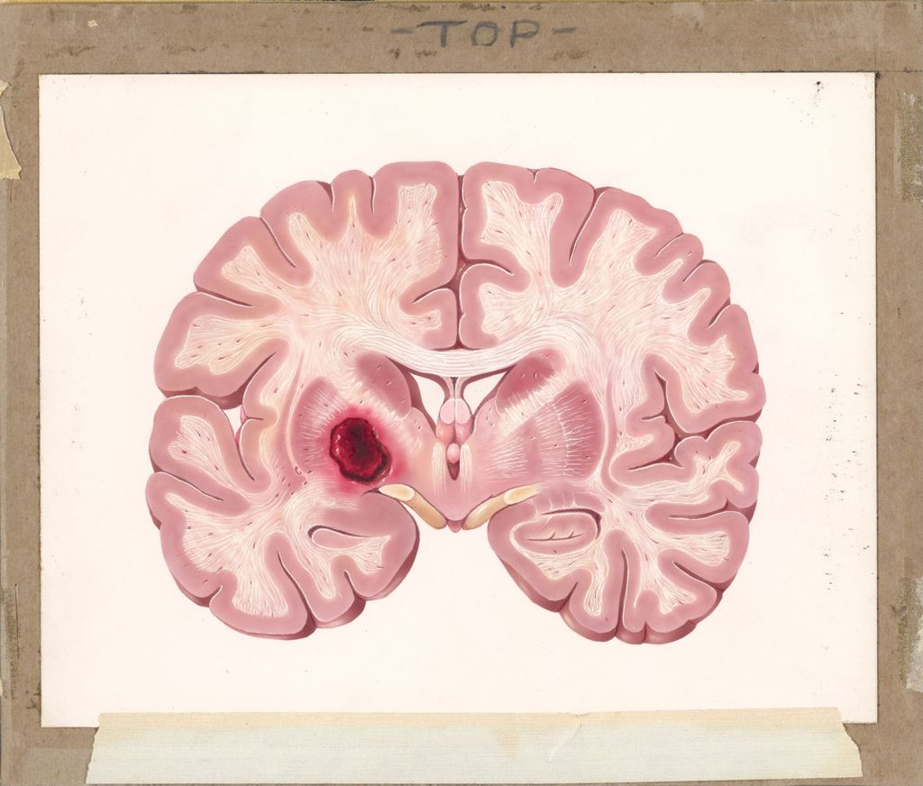 Miniature of Medical Profiles, Diupres and Hydropres, The Effect of Hypertension on Body Organs, Cerebral Hemorrhage