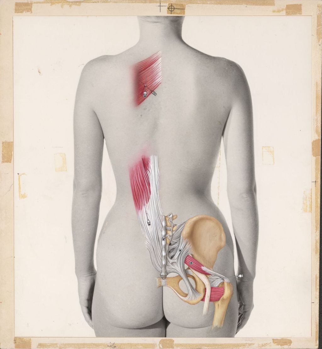 Miniature of Drawing on top of photograph of woman's back, showing muscles In back and hip, with needle insertion points