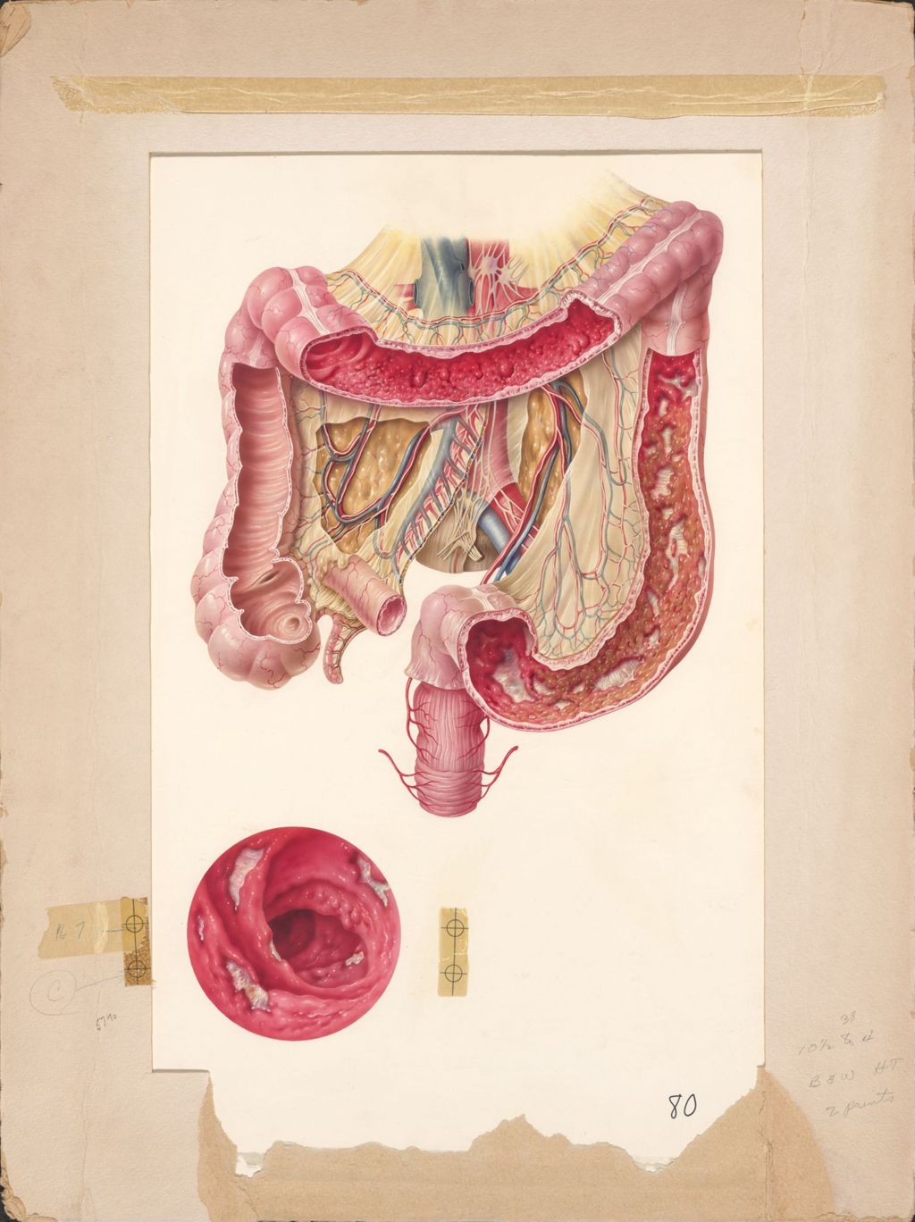 Miniature of Artwork of intestines with cross sections and close up section showing inside of intestine